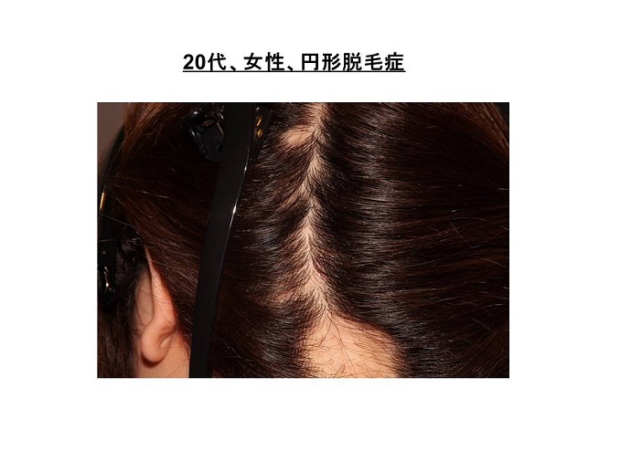 円形脱毛症　病院""